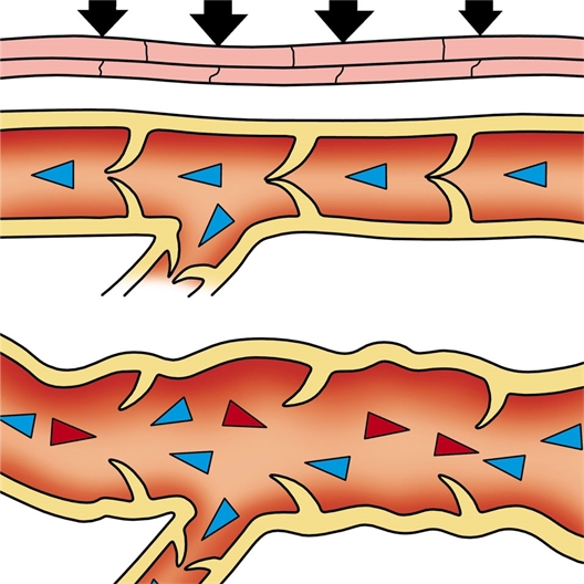 Bottes de pressothérapie : jambe complète ou 1/2 jambre