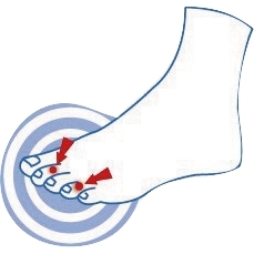 Barrettes sous-diaphysaires : pour homme ou femme